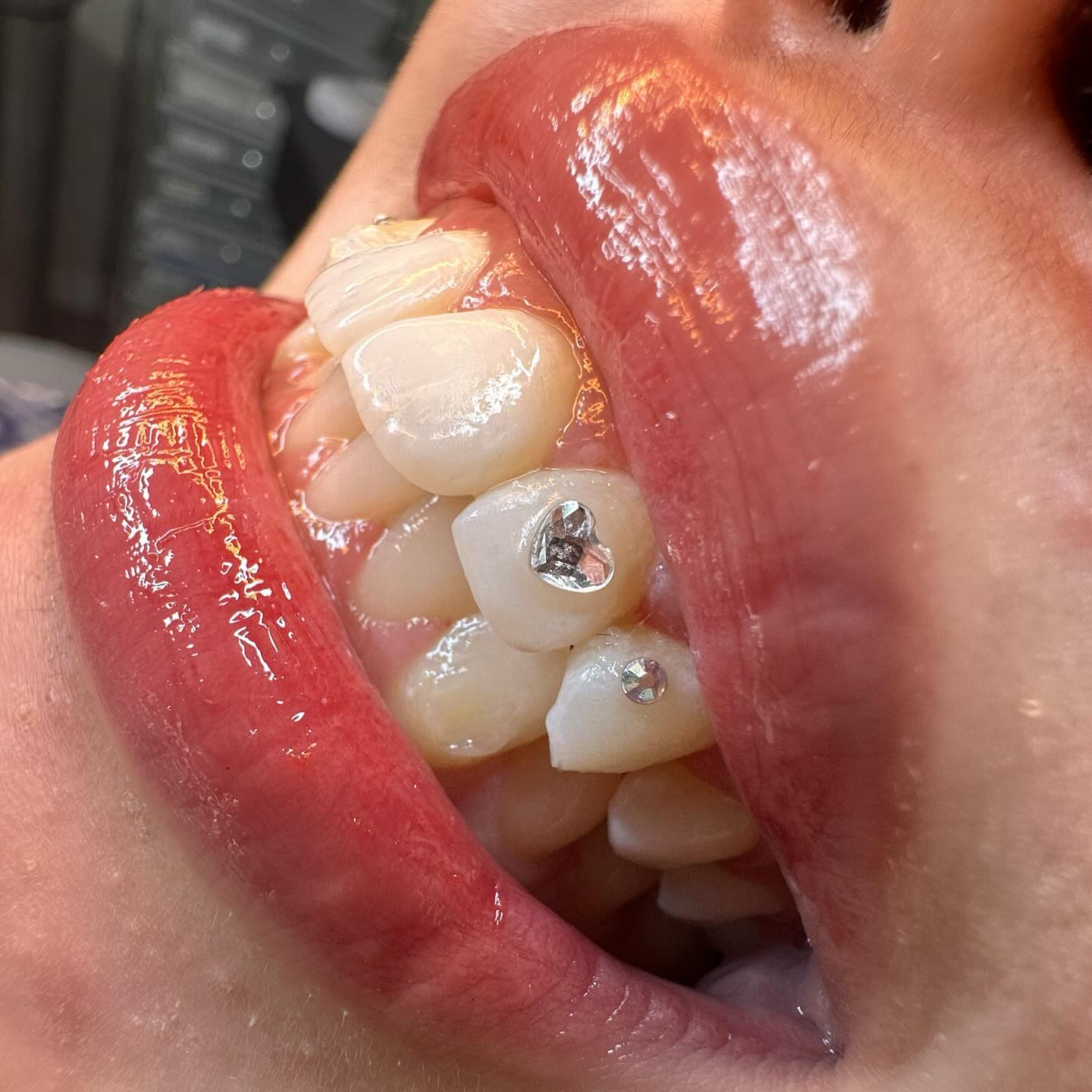 Close-up of tooth gem on molar