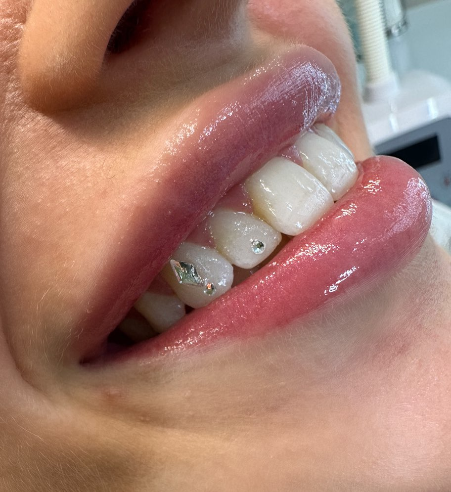 Close-up of clean tooth gems