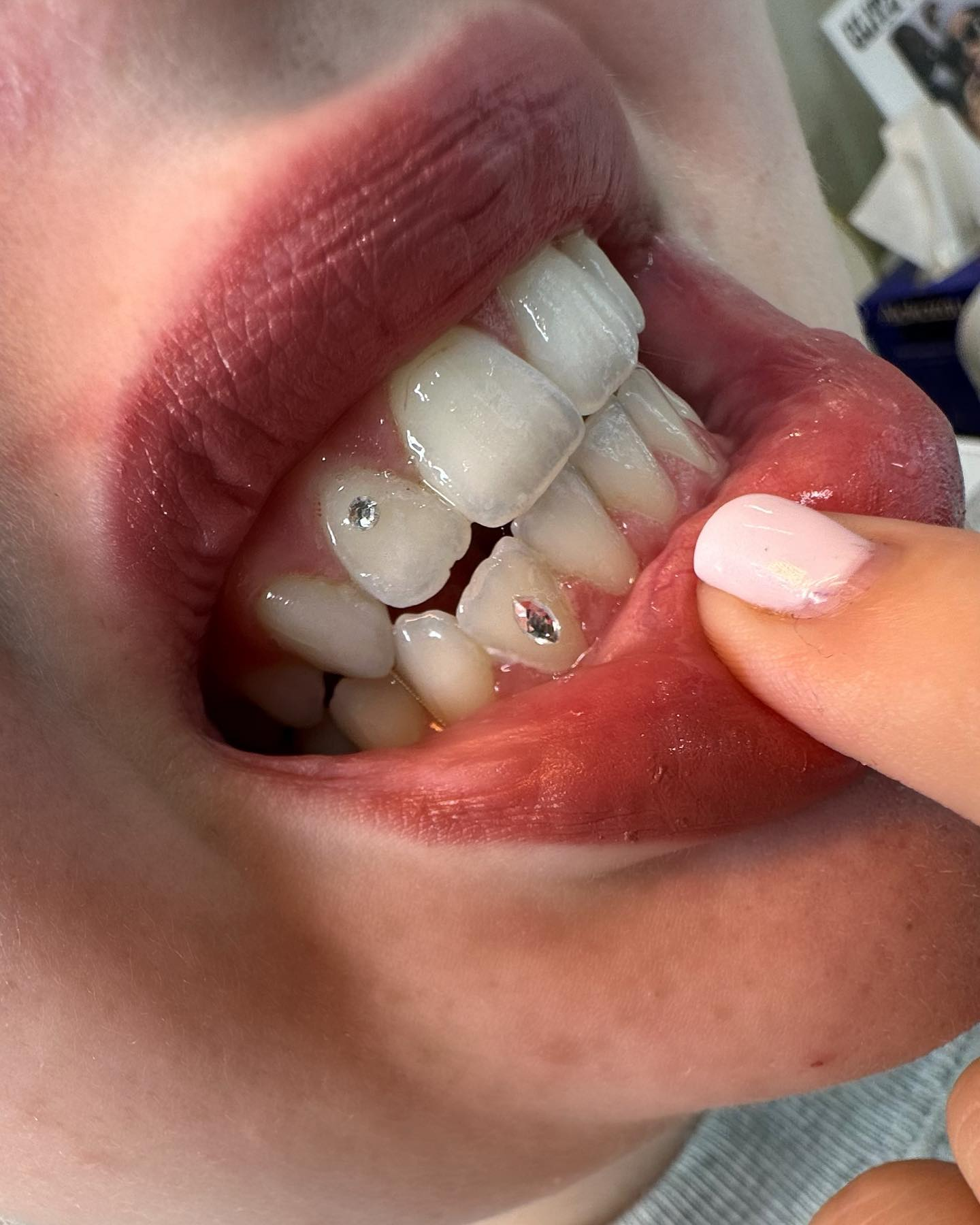 Subtle tooth gem close-up